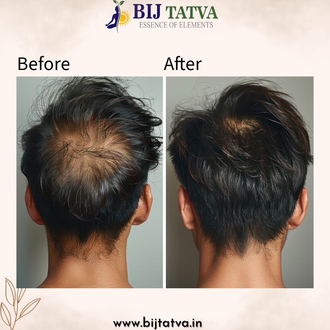 Before and After Results of Ayurvedic Hair Fall Control Solution – Reduced Hair Fall, Stronger Roots, and Visible Hair Regrowth with BIJ Tatva

