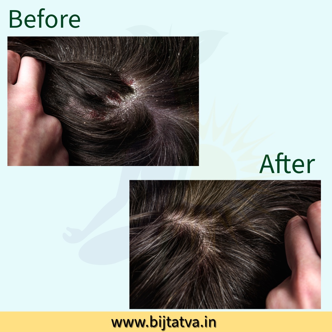 Before and After Results – BIJ Tatva Anti-Dandruff Mask Clears Flakes & Restores Scalp Health Naturally