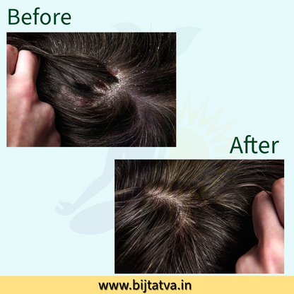 Before and After Results – BIJ Tatva Anti-Dandruff Mask Clears Flakes & Restores Scalp Health Naturally